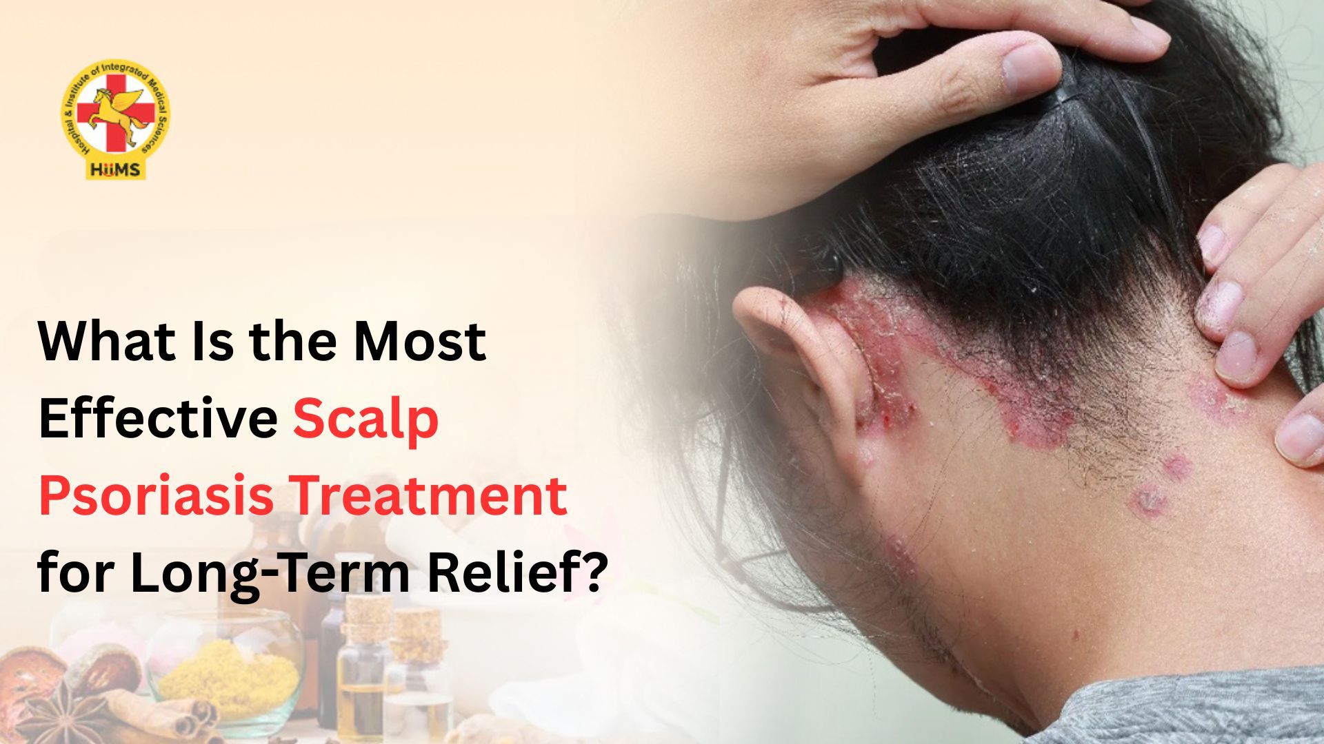 What Is the Most Effective Scalp Psoriasis Treatment for Long-Term Relief?