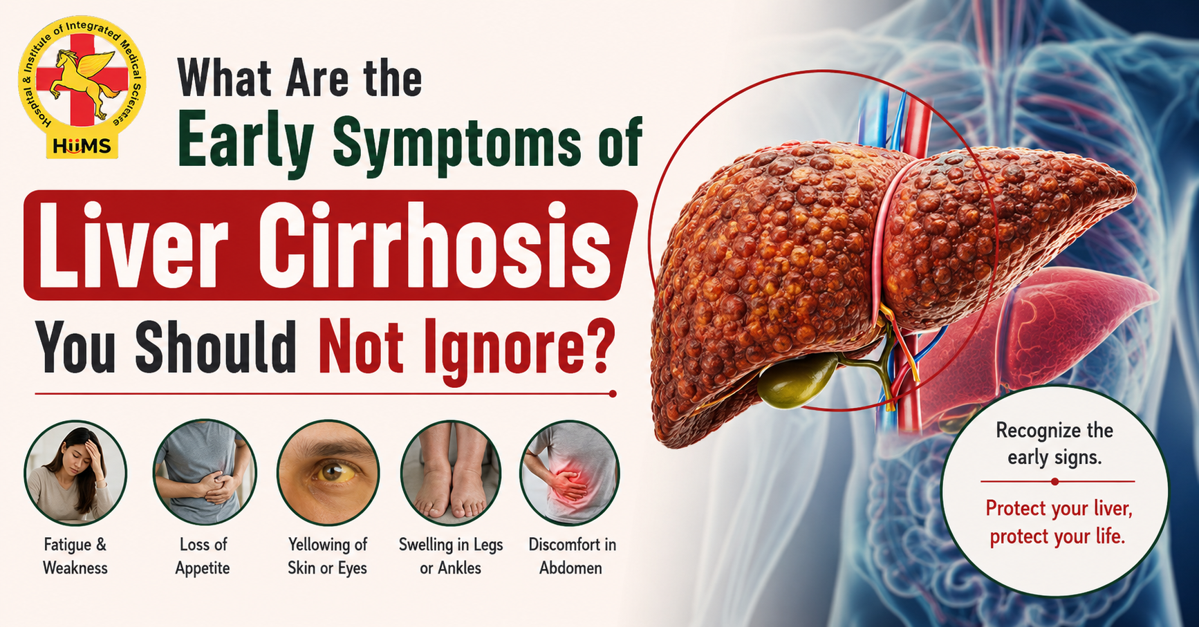 What Are the Early Symptoms of Liver Cirrhosis You Should Not Ignore?